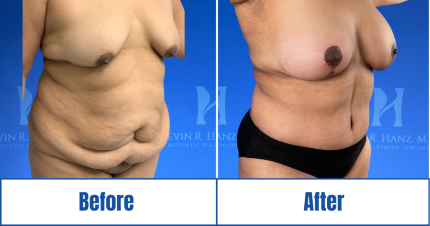 Alternate view of before-and-after result of Mommy Makeover of a woman in Dallas, TX