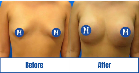 breast-augmentation-before-after-result Breast augmentation before-and-after result of a woman in Dallas, TX