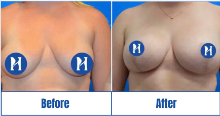 Front profile of before-and-after result of breast augmentation of a woman in Dallas, TX
