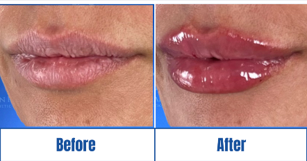 Lip filler before-and-after result of a woman in Dallas, TX