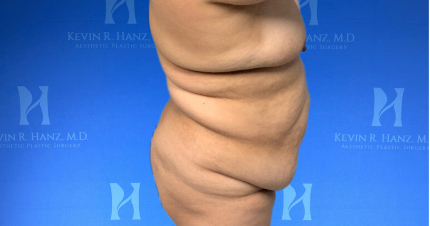 Mommy makeover side profile before surgery of a woman in Dallas, TX