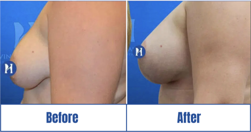 Side profile of before-and-after result of breast augmentation of a woman in Dallas, TX