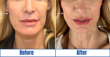 trilift-before-after-result TriLift before and after result of a woman in Dallas, TX