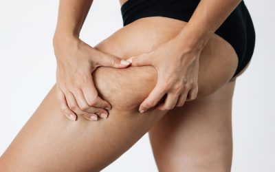 Why Liposuction Alone Does Not Fix Loose Skin