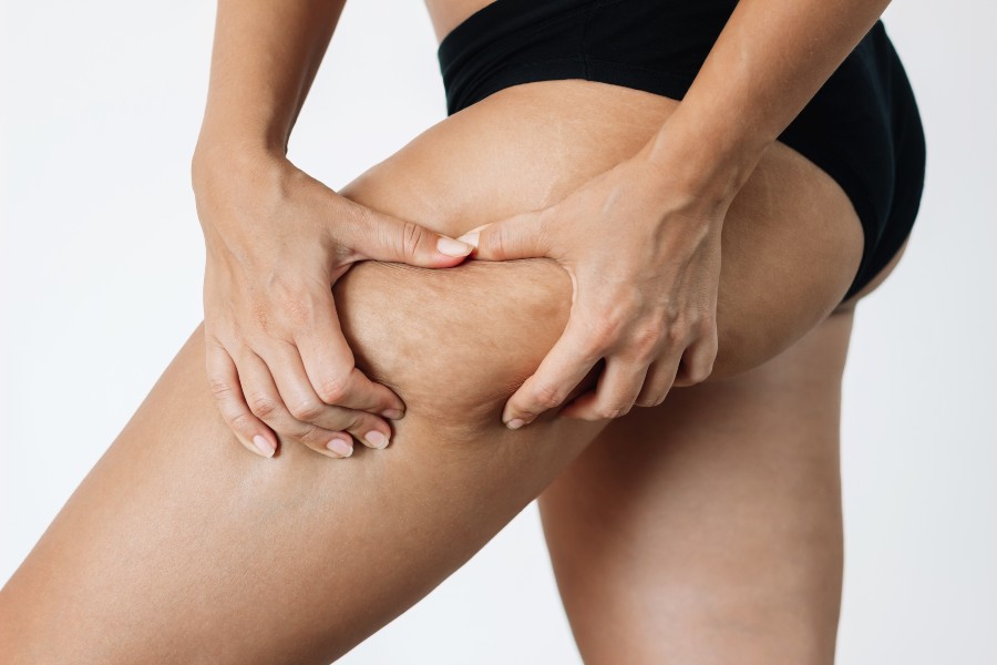 Why Liposuction Alone Does Not Fix Loose Skin